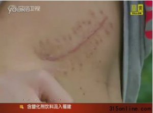 17岁高中生为买iPad2 2万元卖掉右肾