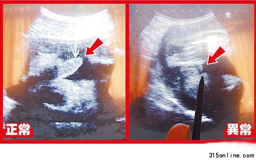 超声波可看到胎儿生殖器,左图箭头处为28周正常男婴生殖器:右图箭头处为异常男婴28周时生殖器画面。图片来源:台湾媒体 超声波可看到胎儿生殖器,左图箭头处为28周正常男婴生殖器:右图箭头处为异常男婴28周时生殖器画面。图片来源:台湾媒体
