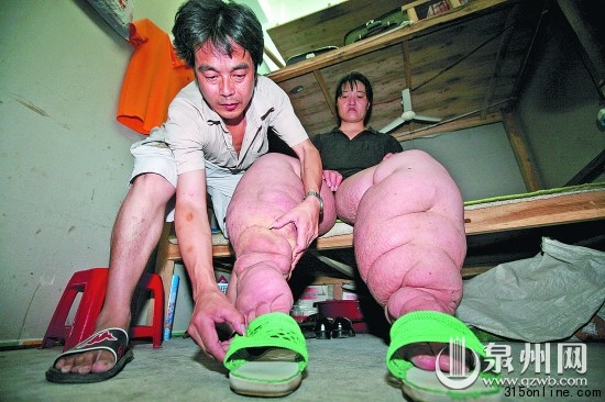 女子身患怪病22年双腿粗比十年大树干(组图)