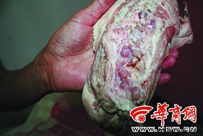 甲状腺未摘除干净的“雨润问题肉” 甲状腺未摘除干净的“雨润问题肉”