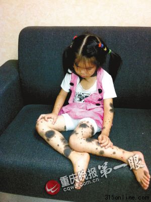 五岁女孩两三年里满身长痣需实施数次手术(图)