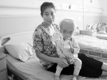 “大头娃娃”脑外积水头围65厘米大脑萎缩(图)