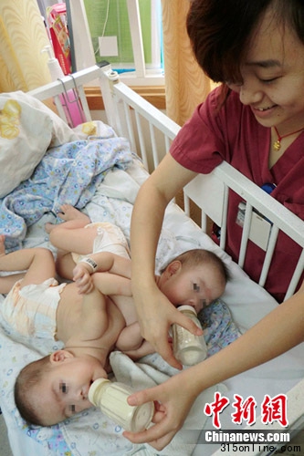 出生五个月的联体女婴在上海成功分离(图)