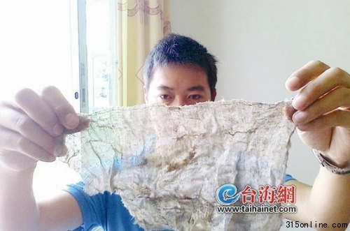 女子产子后体内遗留纱布医院称系操作失误所致