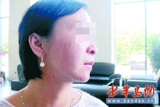 徐女士的脸上经过祛斑美容后,反倒长了不少小痘痘。 徐女士的脸上经过祛斑美容后,反倒长了不少小痘痘。