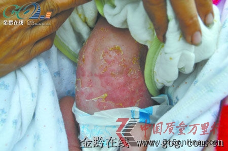脱皮的婴儿。(图片来源:金黔在线)