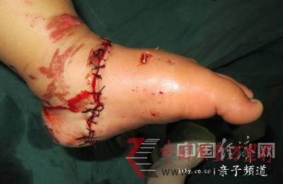 电瓶车咬断女童左脚医生呼吁强制安装防护网(图)
