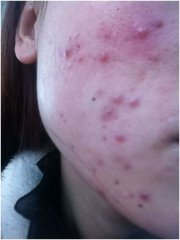 无限极向长出满脸痘消费者退款 被指传销